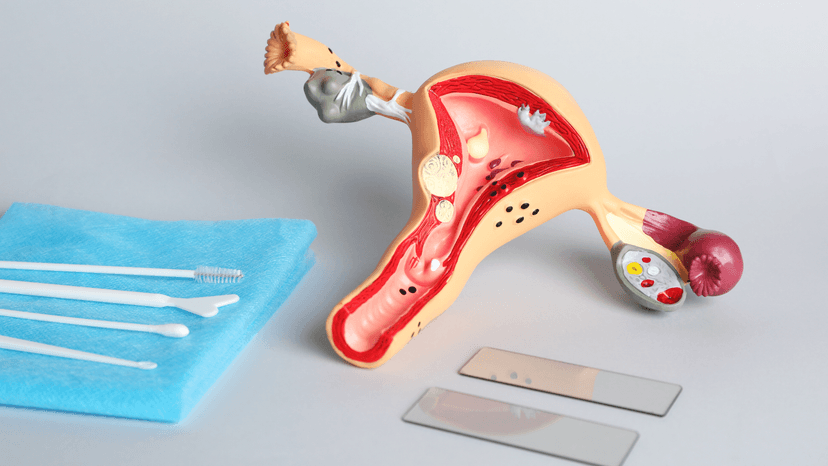 Prueba de Papanicolaou alterada: ¿cuáles son los siguientes pasos?