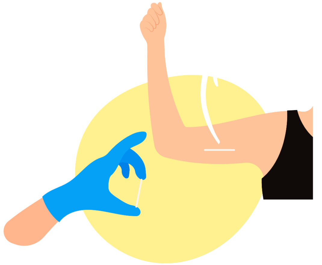 Implante subdérmico